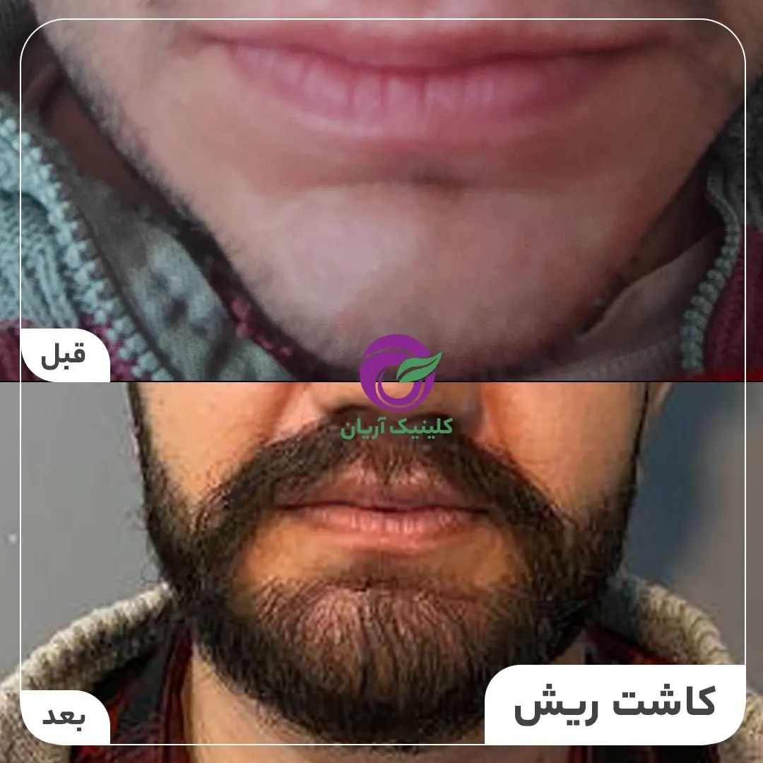 گالری کاشت ریش و سبیل